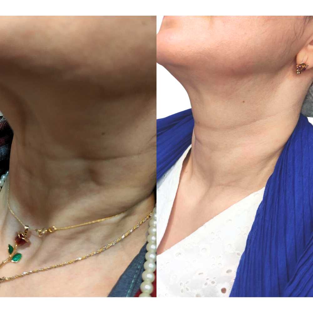 Fractional RF Neck Rejuvenation Treatment