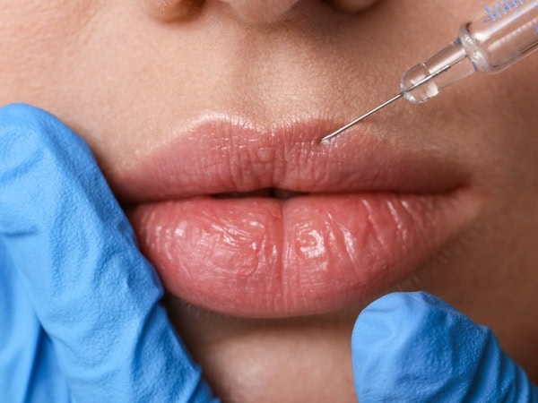 Hyaluronic acid lip filler being injected into the upper lip with a fine needle