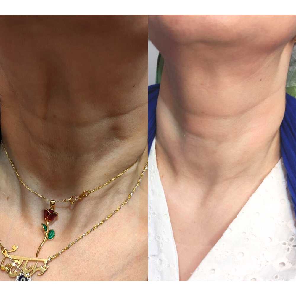 Fractional RF Neck Rejuvenation Treatment