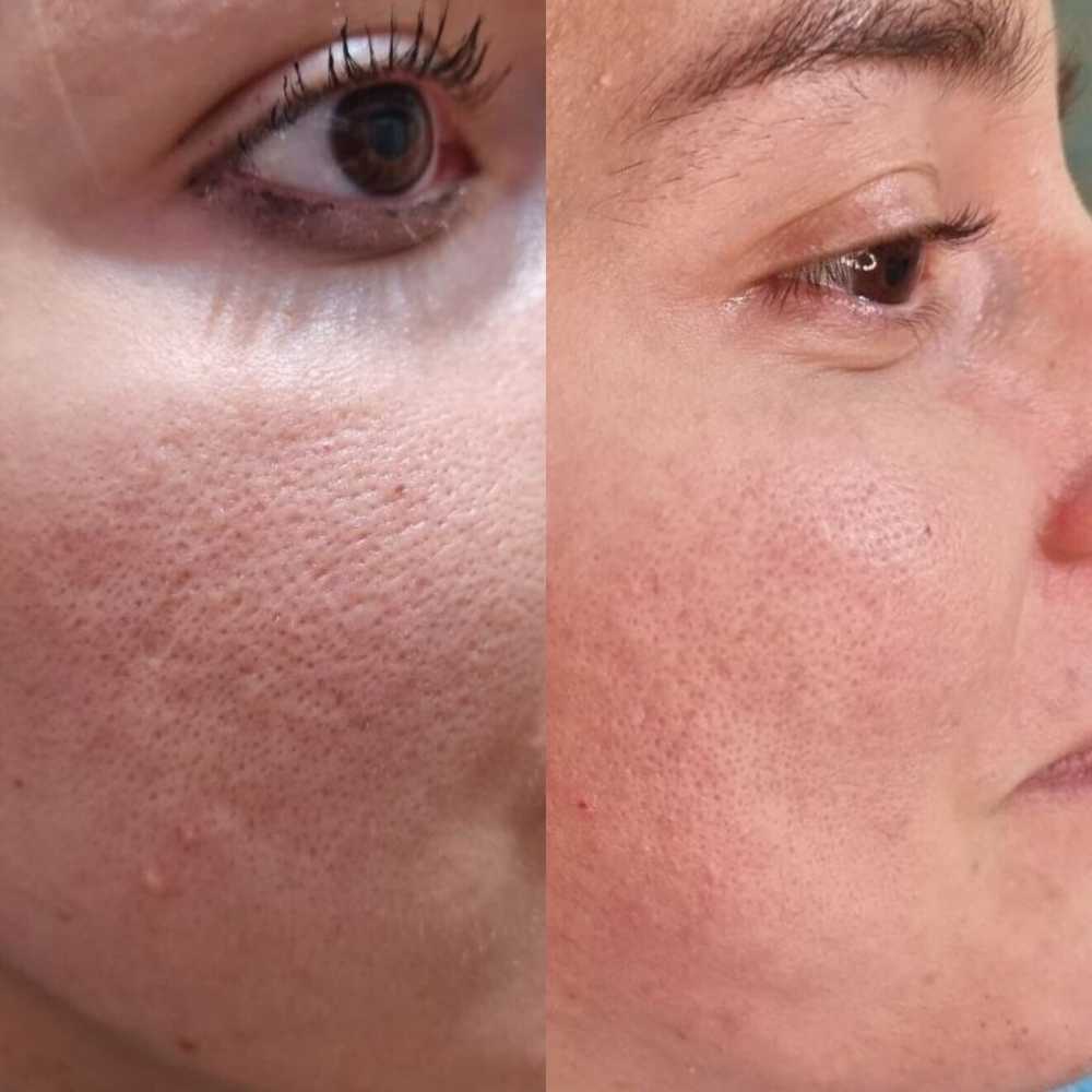Fractional RF treatment