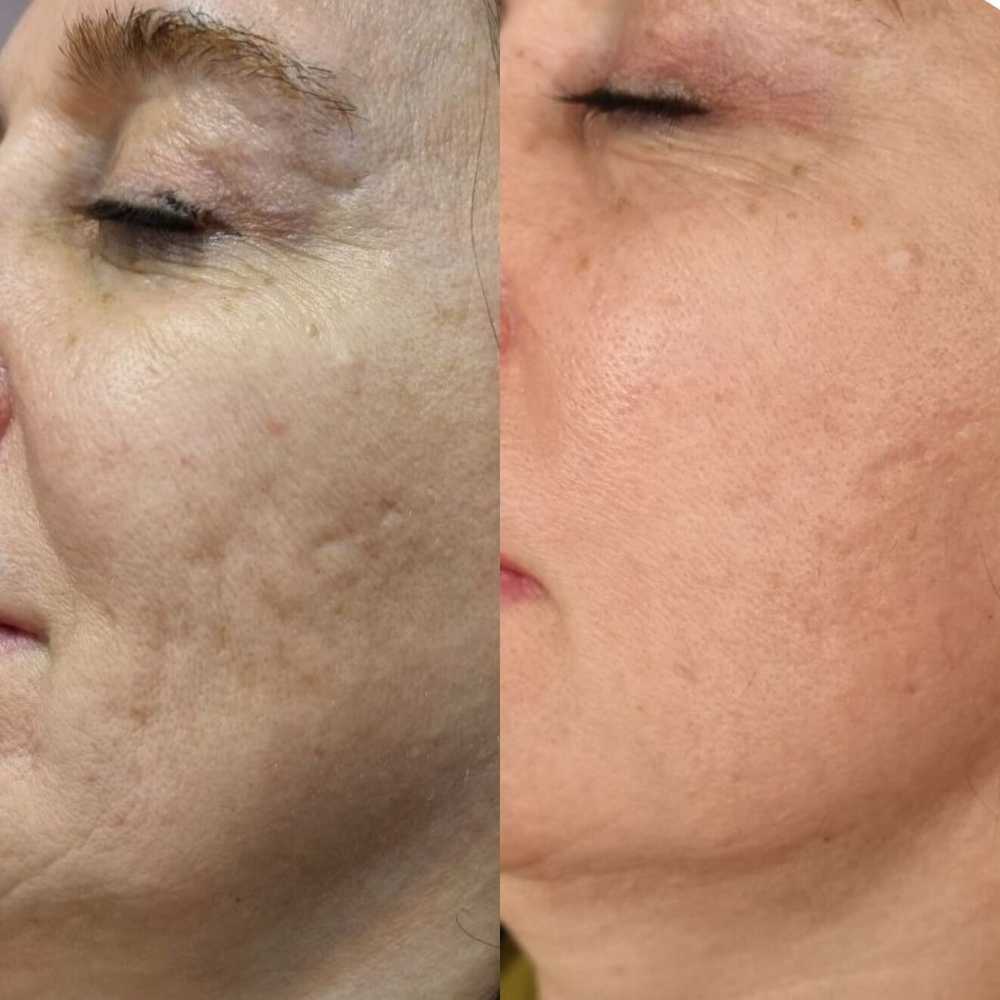 Fractional RF treatment