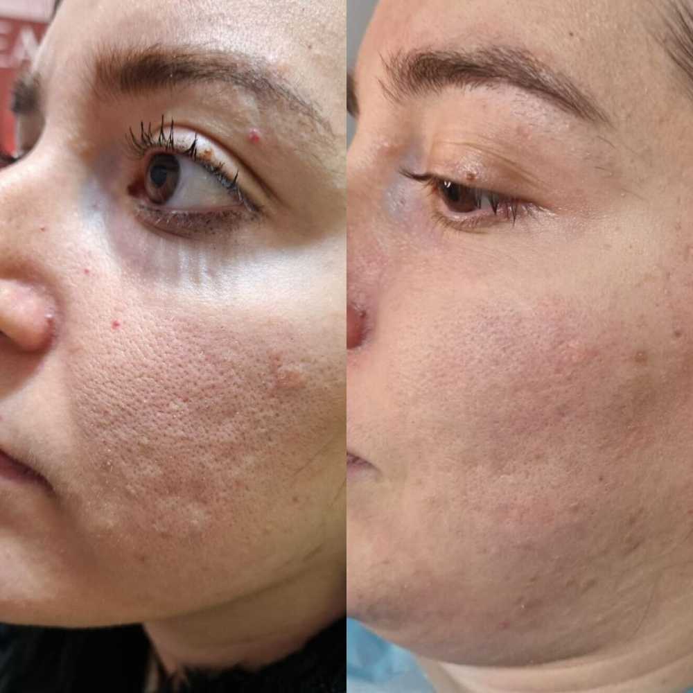 Fractional RF treatment