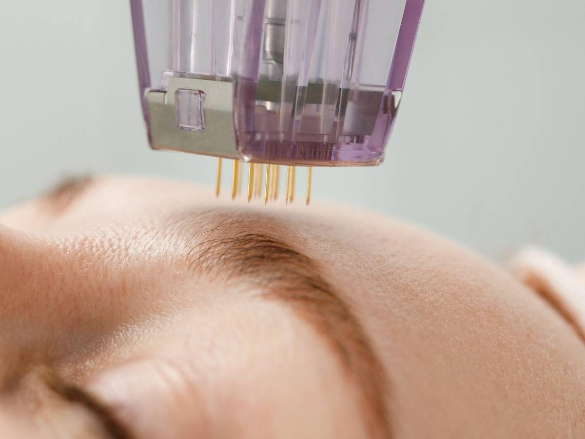 rf fractional