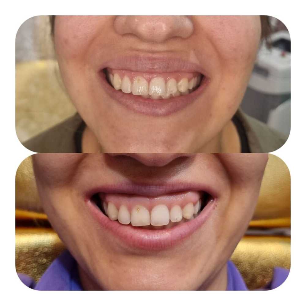 Botox for Gummy Smile Correction