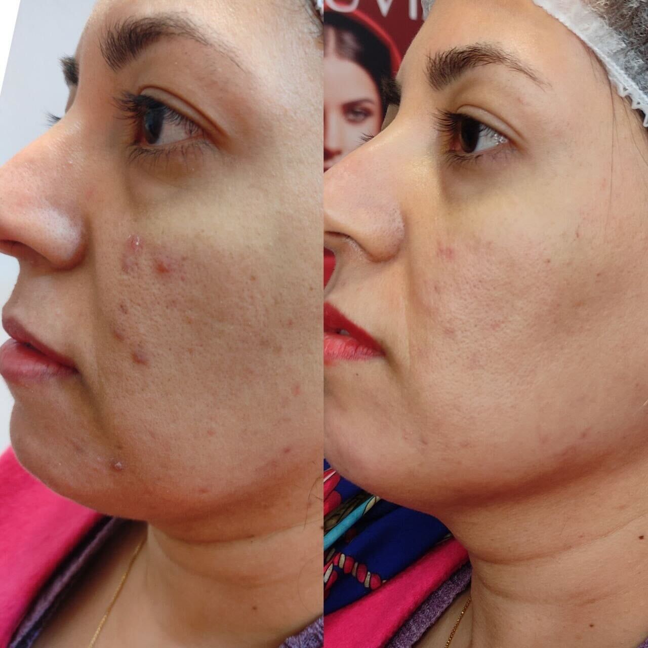 Microneedling