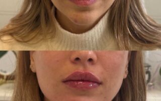 Lip filler before and after results — Elham Aesthetic Art, North York (7)