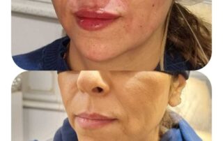 Lip filler before and after results — Elham Aesthetic Art, North York (6)