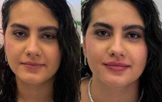 Lip filler before and after results — Elham Aesthetic Art, North York (8)