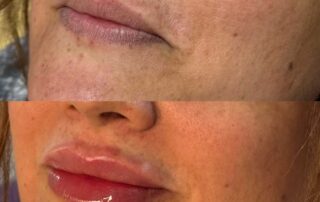 Lip filler before and after results — Elham Aesthetic Art, North York (4)