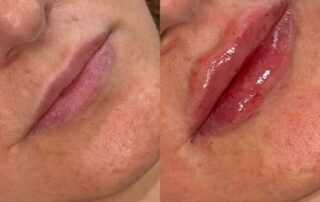 Lip filler before and after results — Elham Aesthetic Art, North York (5)