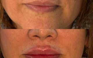 Lip filler before and after results — Elham Aesthetic Art, North York (2)