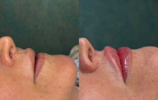 Lip filler before and after results — Elham Aesthetic Art, North York (1)
