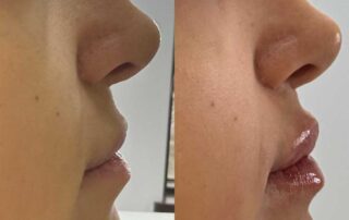 Lip filler before and after results — Elham Aesthetic Art, North York (9)