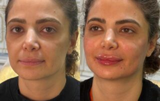 Lip filler before and after results — Elham Aesthetic Art, North York (10)