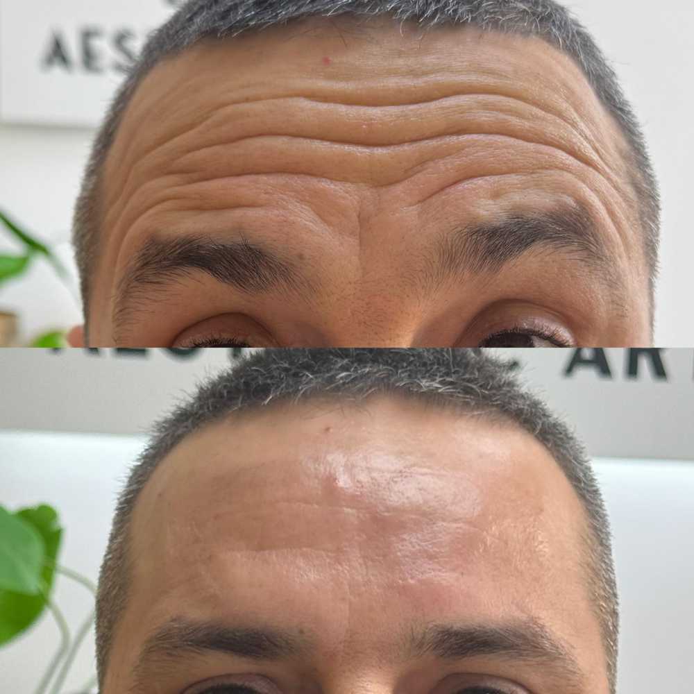 Botox for fine line and wrinkle treatment