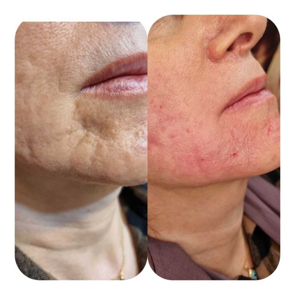 Fractional RF Fine lines and wrinkles