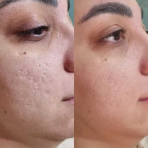 Fractional RF treatment