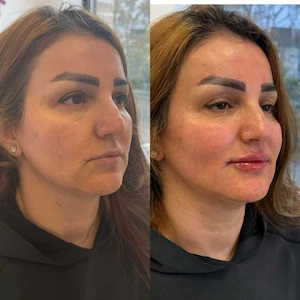 Sculptra and Lip filler