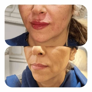 Lip Filler Injections for Natural-Looking Volume
