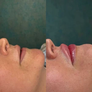 Lip Filler Injections for Natural-Looking Volume