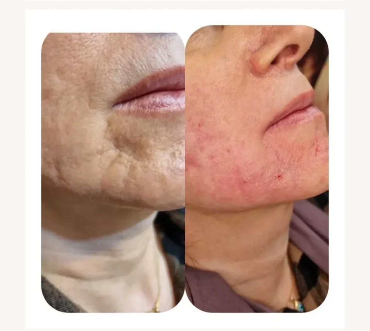 RF fractional treatment before and after results at Elham Aesthetic Art, North York — improved skin texture and radiance