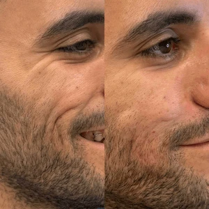 Radiesse
