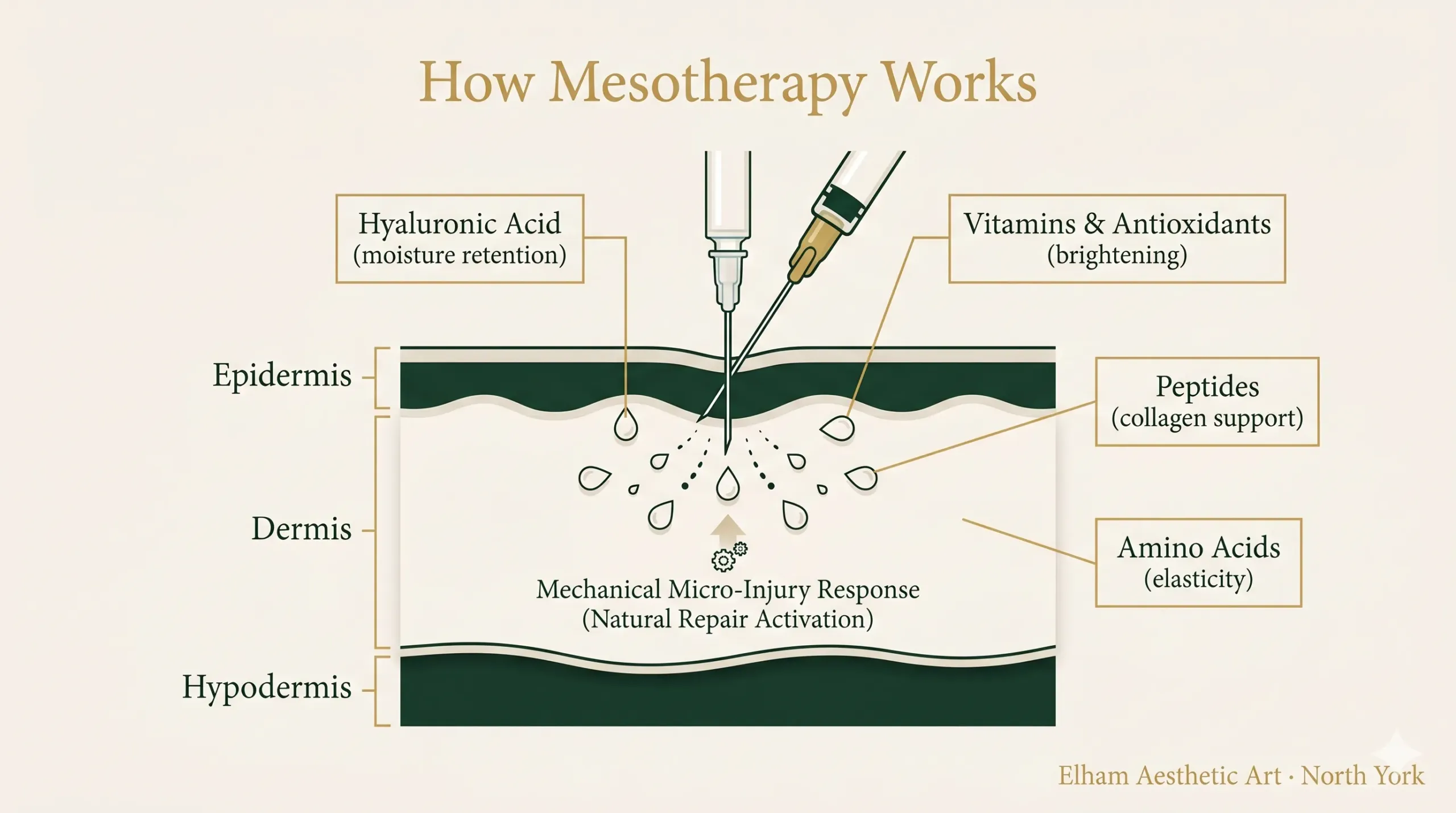 Infographic showing how mesotherapy micro-injections deliver hyaluronic acid, vitamins and peptides into the skin dermis at Elham Aesthetic Art North York