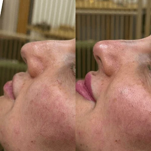 Lip Filler Injections for Natural-Looking Volume