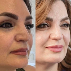 Nose Thread Lift, Lip Fillers, and Full-Face Botox