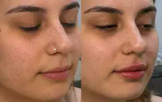 Lip filler before and after results — Elham Aesthetic Art, North York (11)