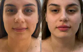 Lip filler before and after results — Elham Aesthetic Art, North York (12)