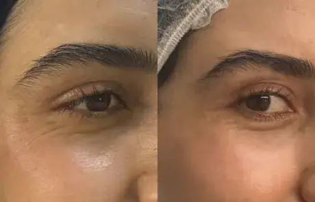 PRF eye rejuvenation before and after — Elham Aesthetic Art, North York (1)