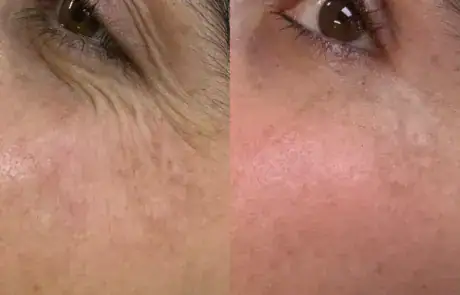 PRF eye rejuvenation before and after — Elham Aesthetic Art, North York (2)